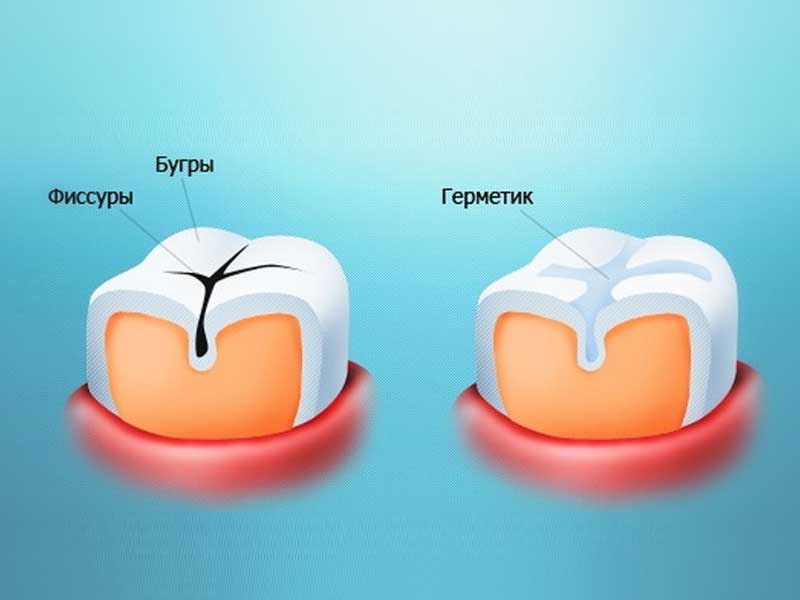 Герметизация фиссур!