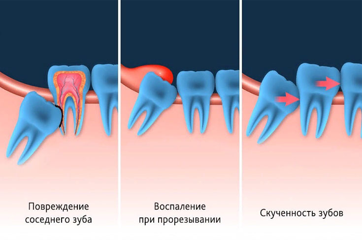 В каких случаях удаляют зуб мудрости?
