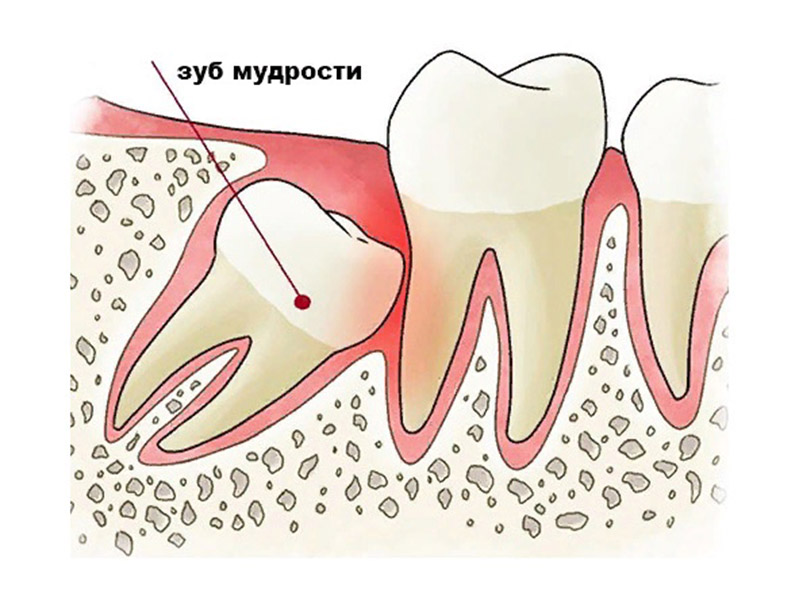 Перикоронит