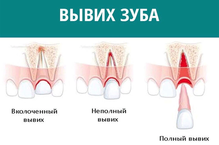 Вывих зуба