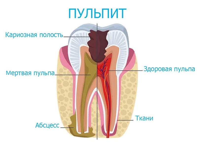 Очаговый (острый) пульпит!
