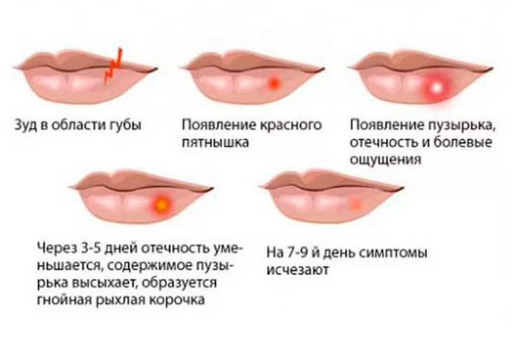 Можно ли лечить зубы с Герпесом?