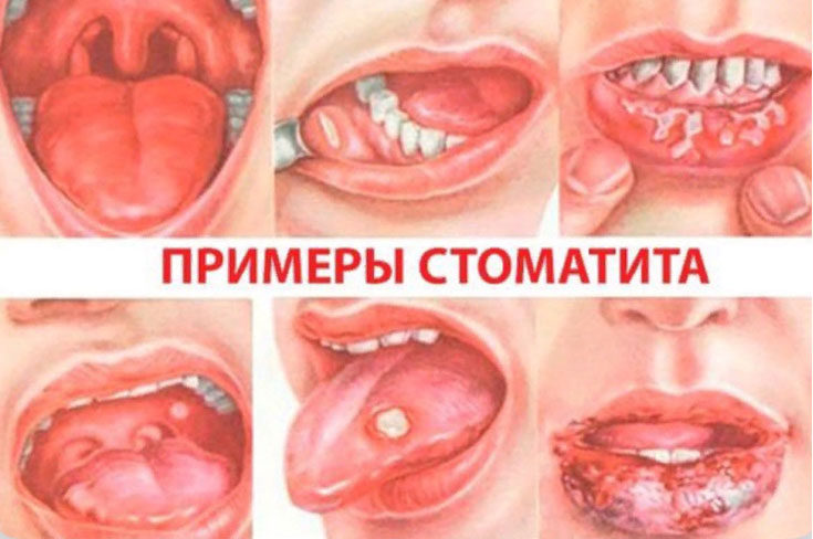 Что такое стоматит?