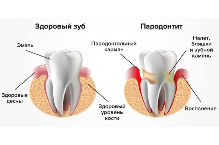 Узнайте, грозит ли вам пародонтит?