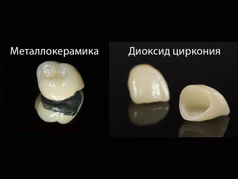 Металлокерамика или диоксид циркония?