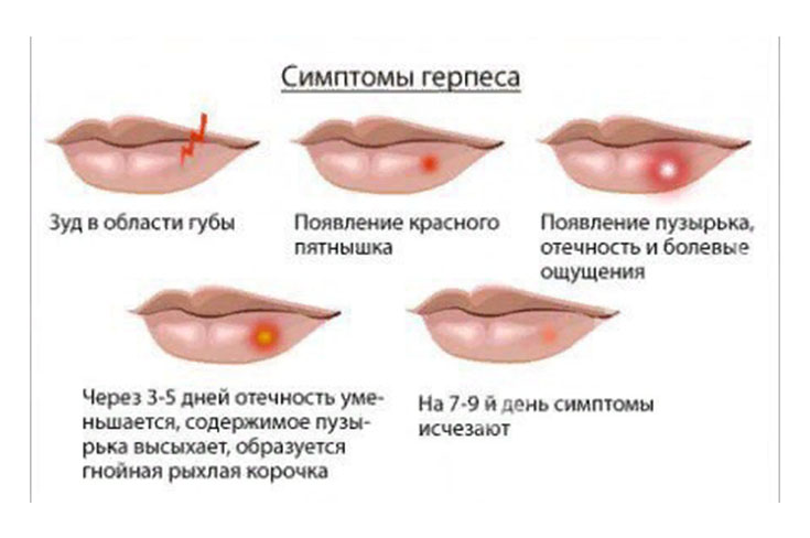 Герпес на губах! Почему нельзя лечиться у стоматолога?