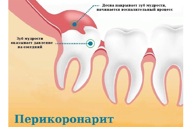Что такое перикоронарит?