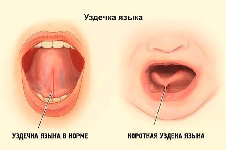 Как обнаружить короткую уздечку языка?