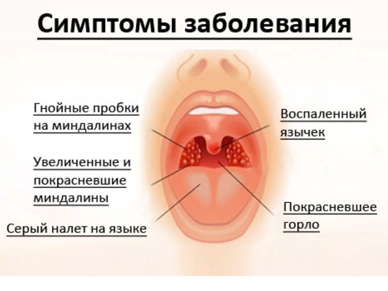 Ангина