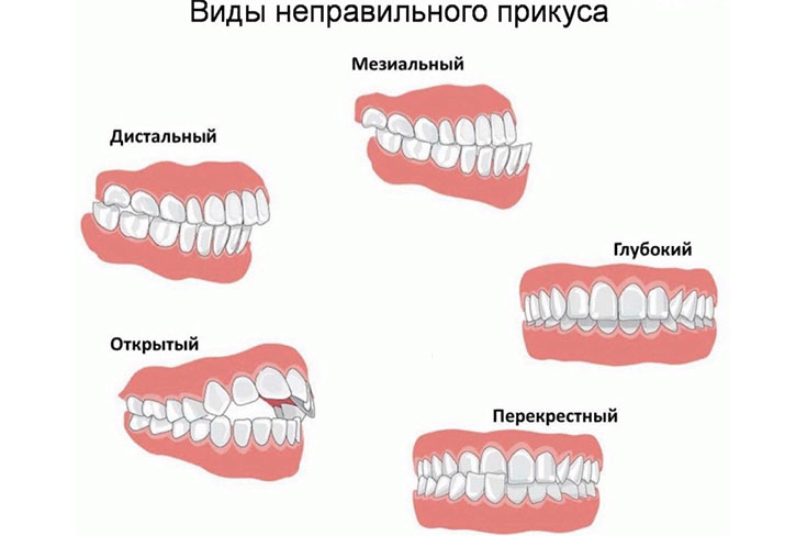 Неправильный прикус у ребёнка - это повод для беспокойства!?