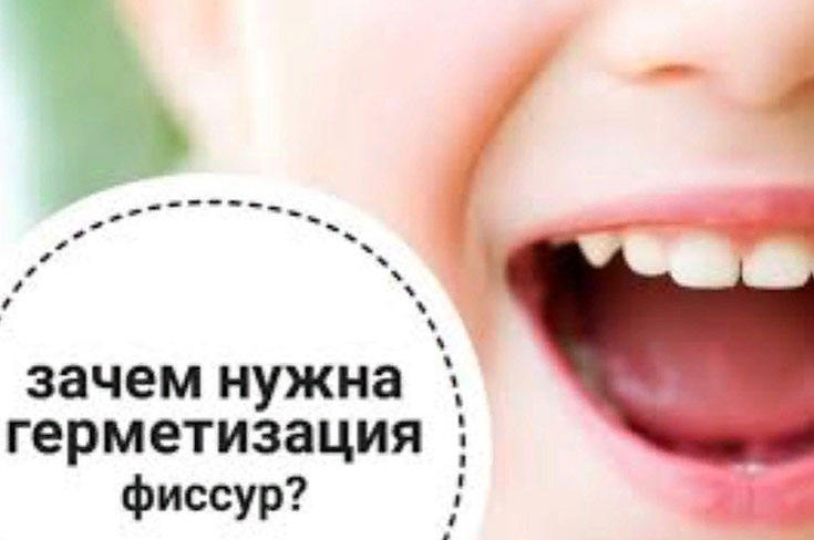 Что такое герметизация фиссур и кому она вообще нужна?